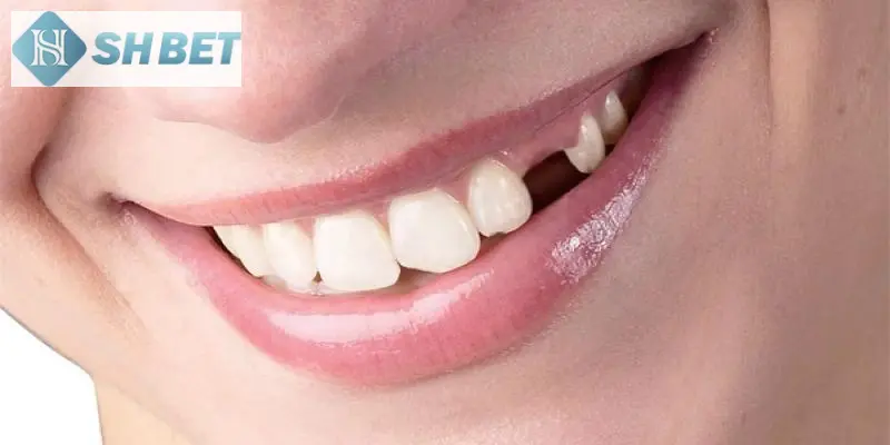 Giải mã giấc mơ nằm mơ rụng răng cùng SHBET ngay!